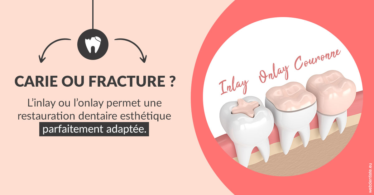 https://dr-francois-vergez.chirurgiens-dentistes.fr/T2 2023 - Carie ou fracture 2
