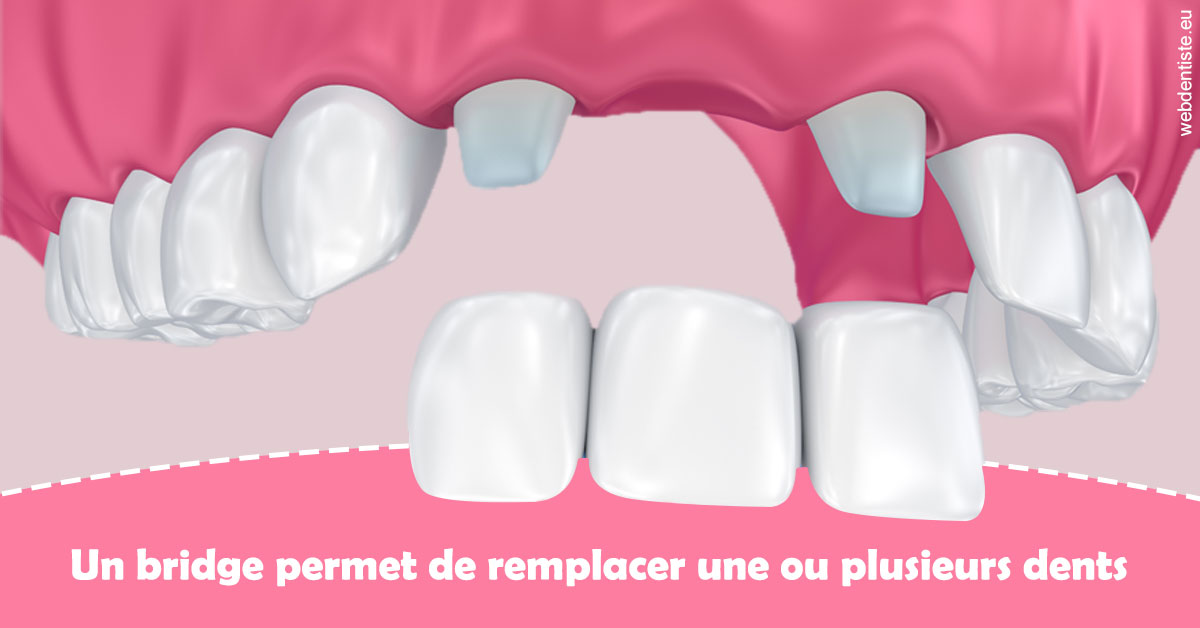 https://dr-francois-vergez.chirurgiens-dentistes.fr/Bridge remplacer dents 2