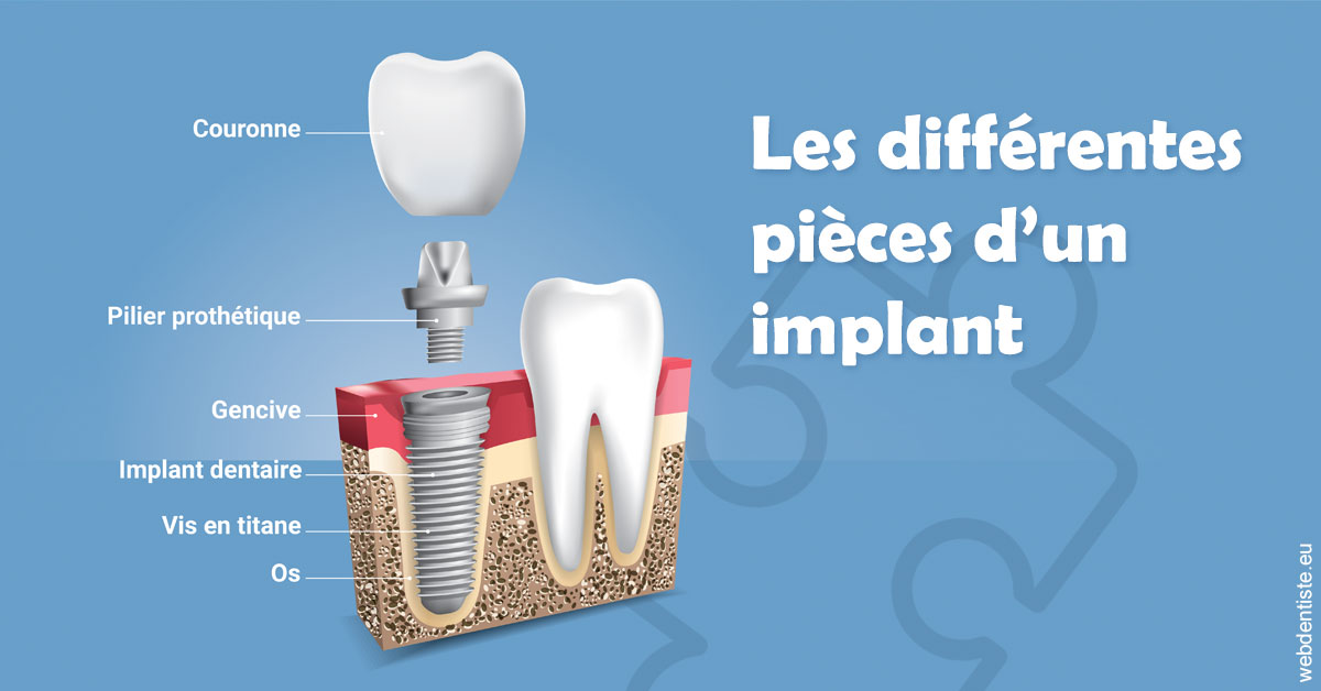 https://dr-francois-vergez.chirurgiens-dentistes.fr/Les différentes pièces d’un implant 1